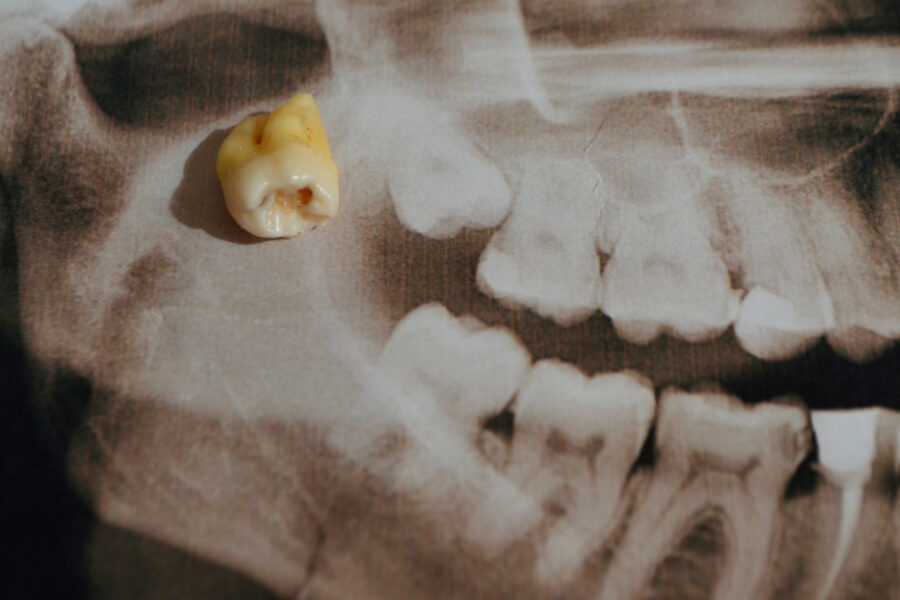 real tooth sitting on dental x-ray