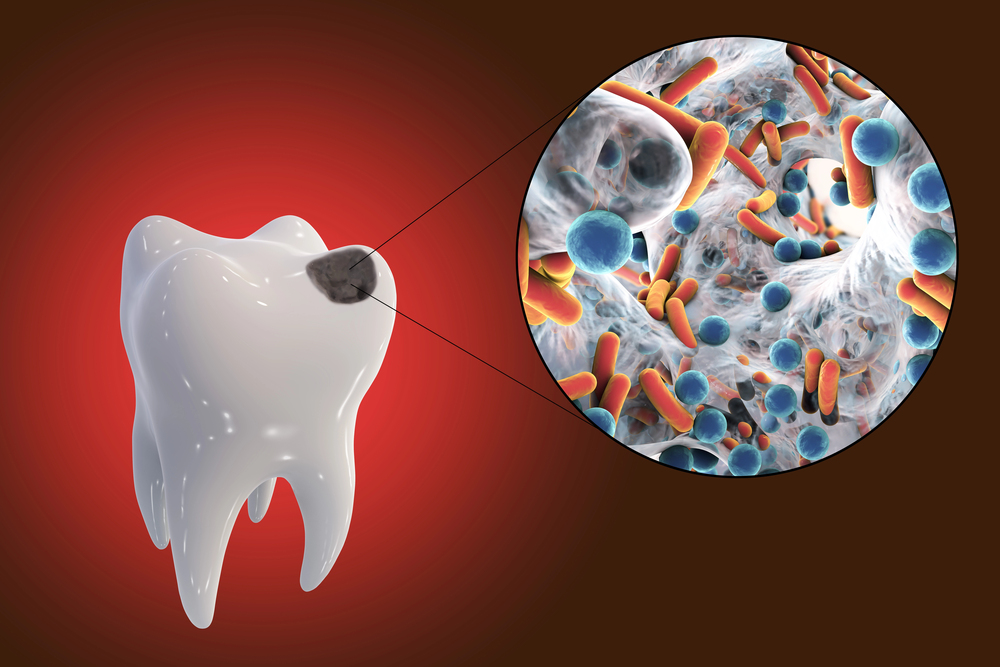 Small Hole in Tooth, Big Problem: Why Early Treatment Matters