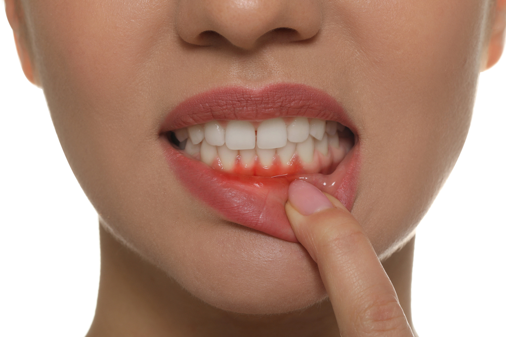 Your General Dentist in Mission, BC = Your Best Chance Against Tooth Loss