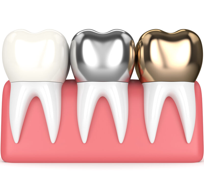 dental crowns