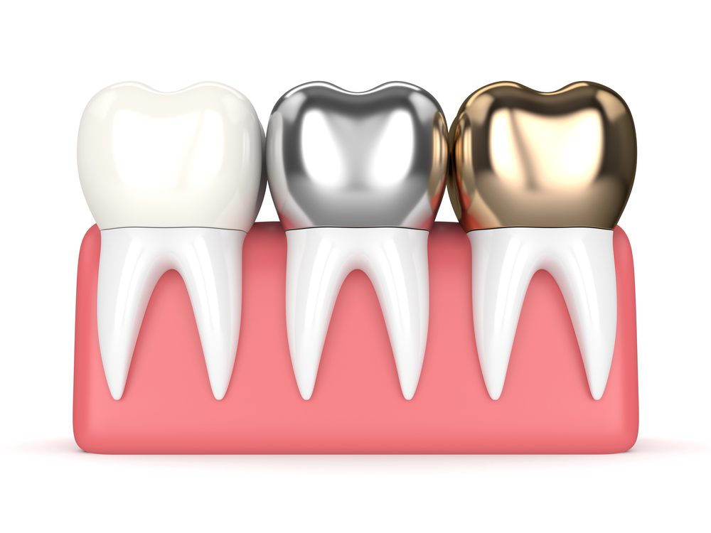 Dental Crowns: When They’re Needed and How They Protect Your Smile