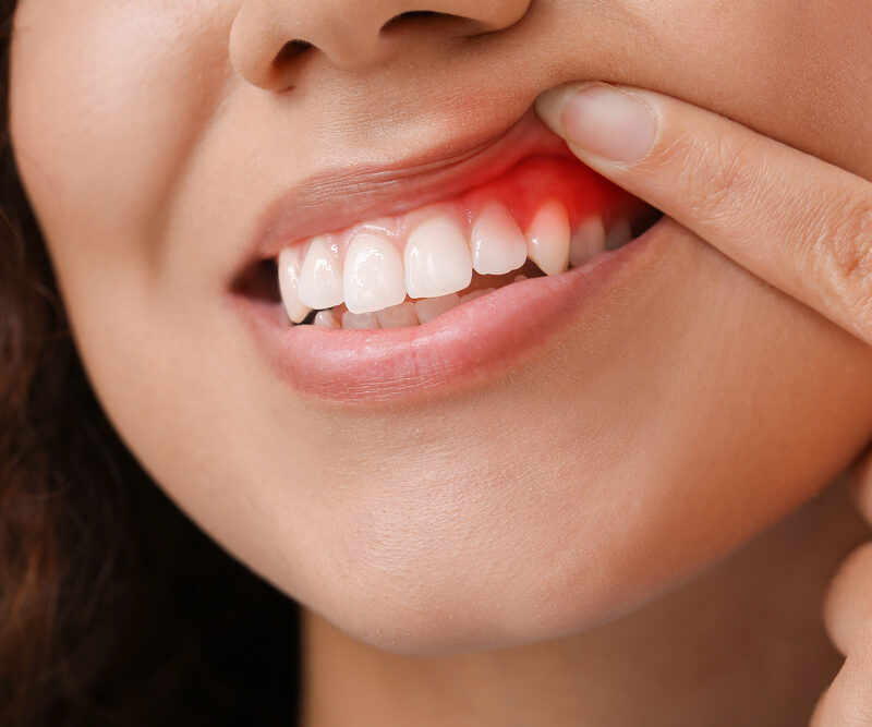 woman showing gum disease