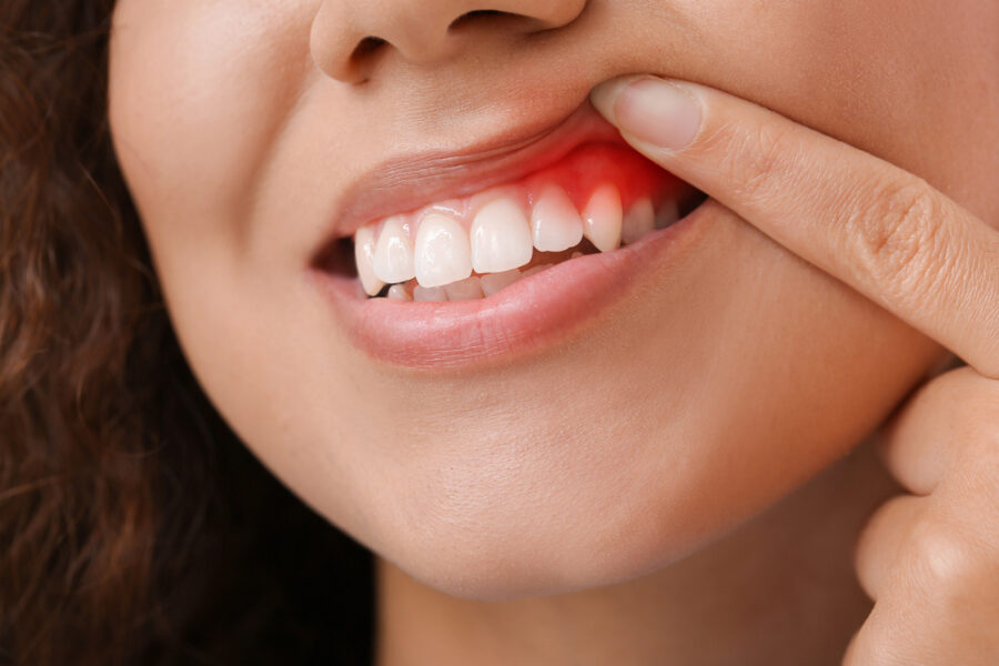 woman showing gum disease